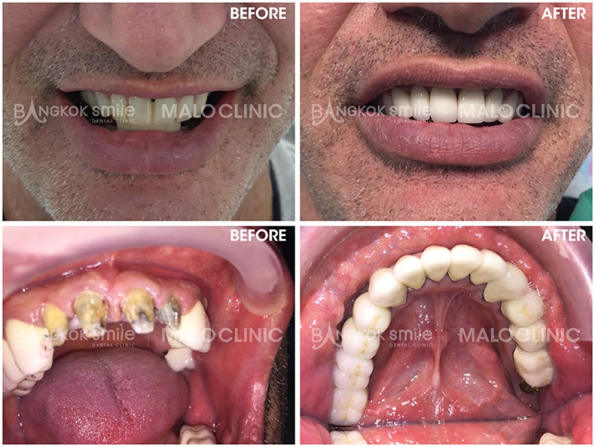 نتائج قبل وبعد زراعة الأسنان All-on-6 في Bangkok Smile Dental Group، استعادة الابتسامة الكاملة
