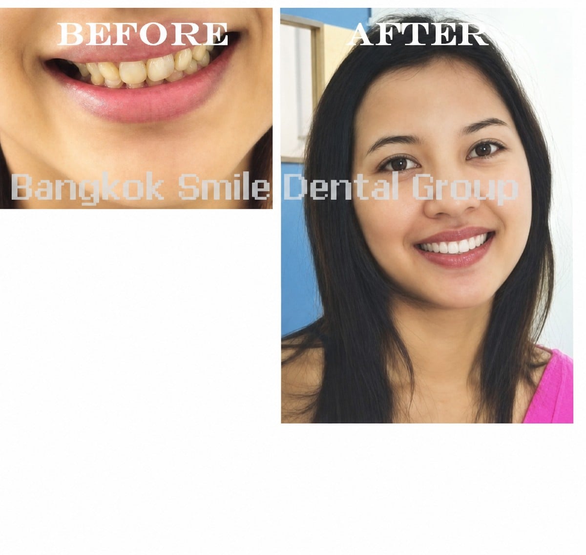 نتائج تبييض الأسنان قبل وبعد في Bangkok Smile Dental Group، ابتسامة أكثر إشراقًا