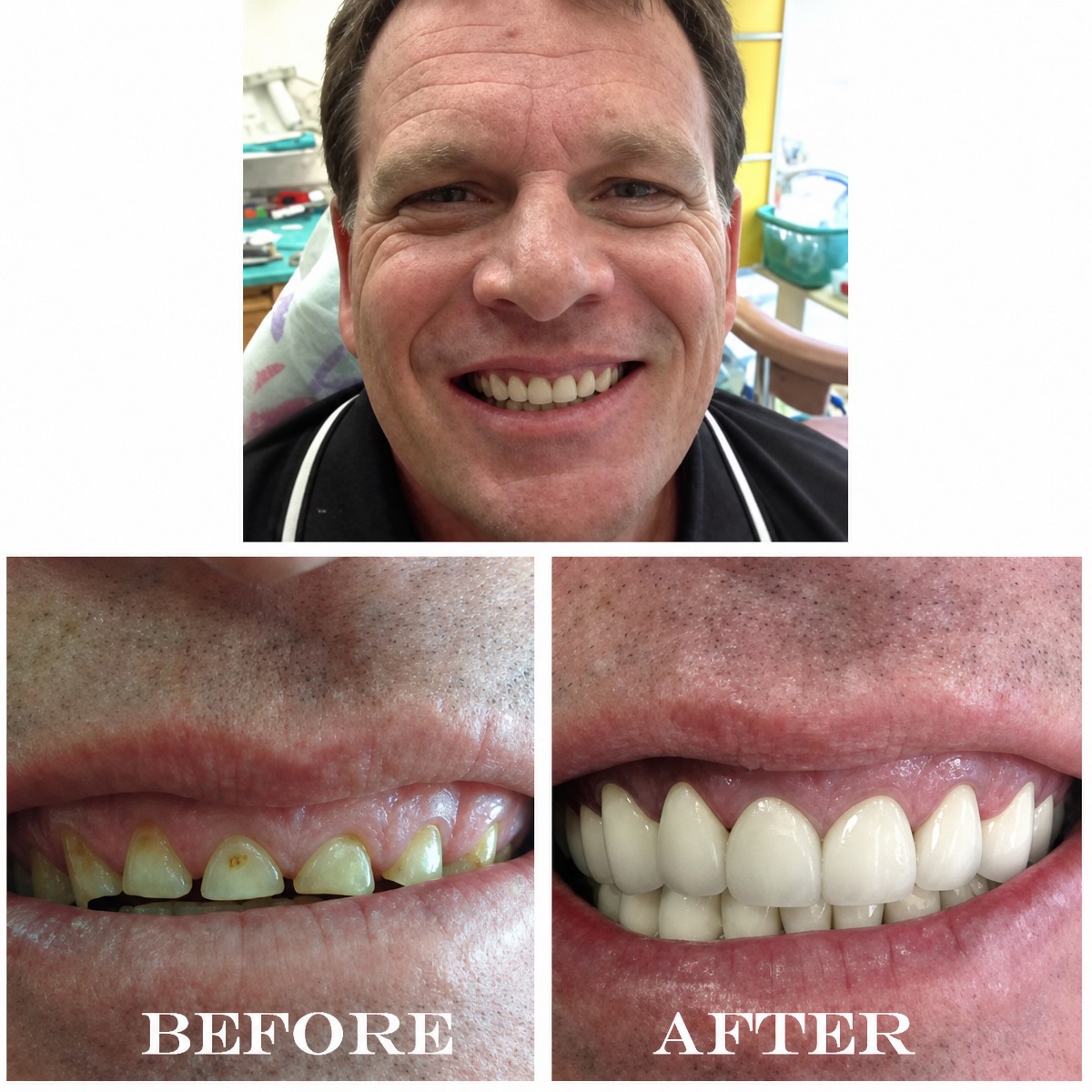 نتائج تبييض الأسنان قبل وبعد في Bangkok Smile Dental Group، ابتسامة أكثر إشراقًا