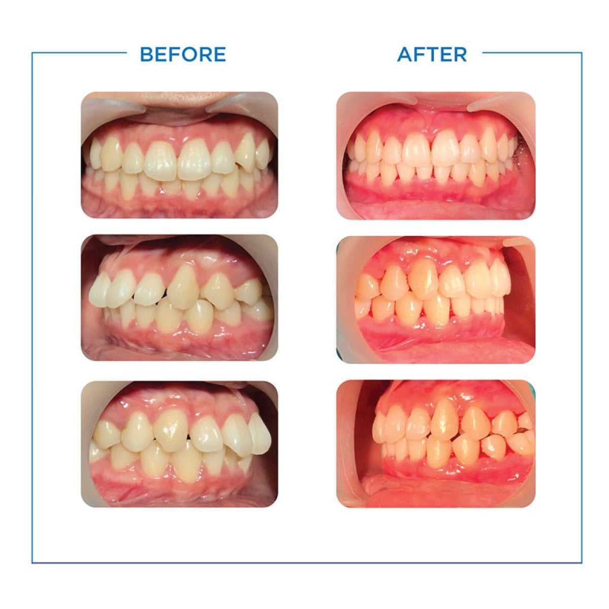 Resultados antes y después de Invisalign en Bangkok Smile Dental Group, mejora de alineación dental