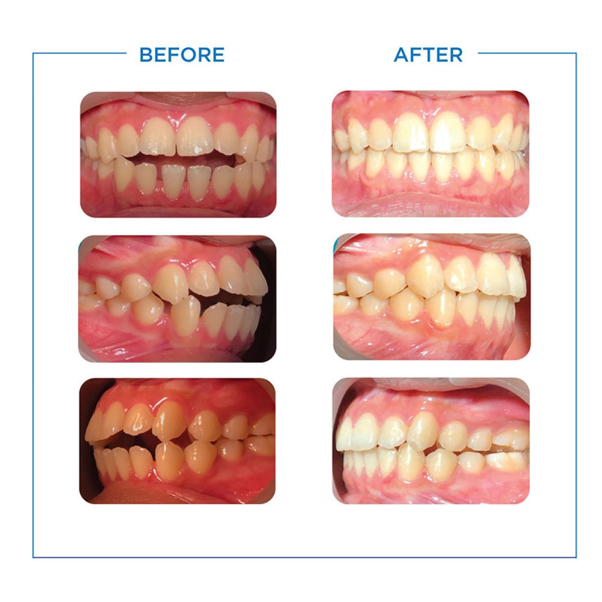 نتائج قبل وبعد تقويم Invisalign في Bangkok Smile Dental Group، تحسين اصطفاف الأسنان