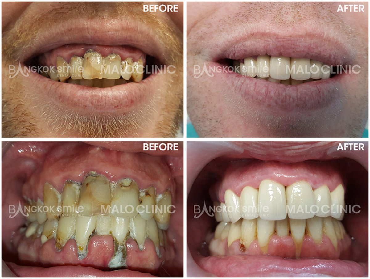 Antes y después de carillas dentales en Bangkok Smile Dental Group, resultados de sonrisa