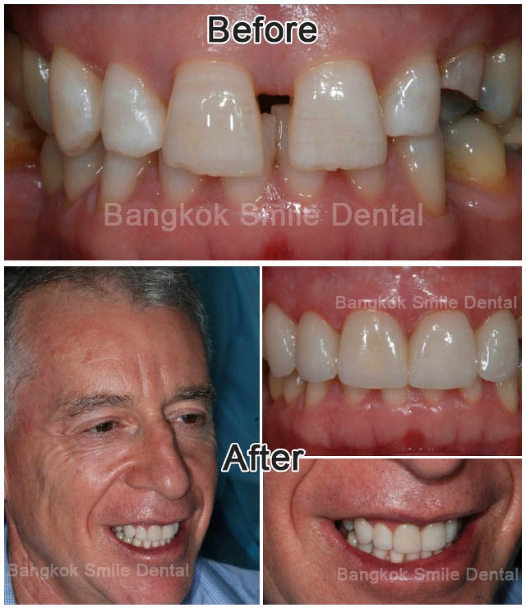 قبل وبعد قشور الأسنان في Bangkok Smile Dental Group – نتائج تجميل الابتسامة