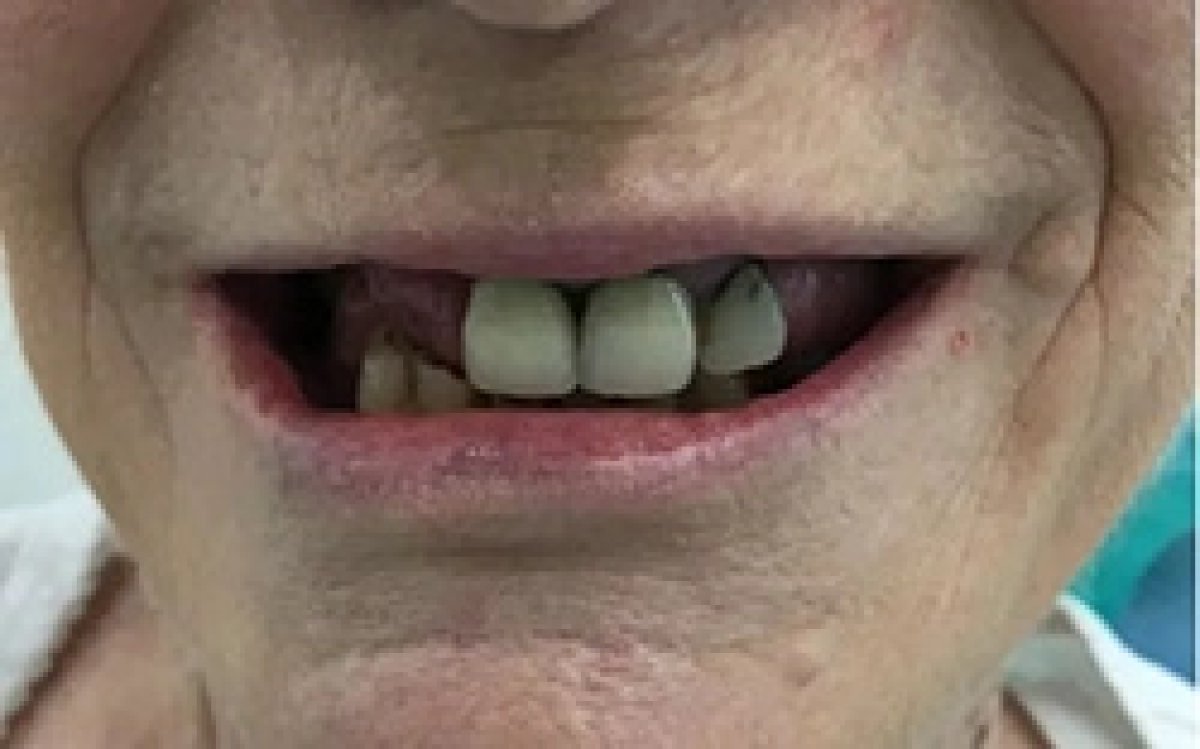 قبل تركيب تيجان الأسنان في Bangkok Smile Dental Group، تظهر أسنان مفقودة ومتضررة
