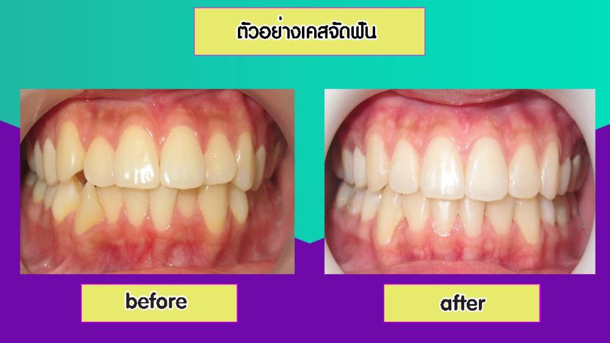 نتائج تبييض الأسنان قبل وبعد في Siam Station Dental Clinic، أسنان أكثر بياضًا بوضوح