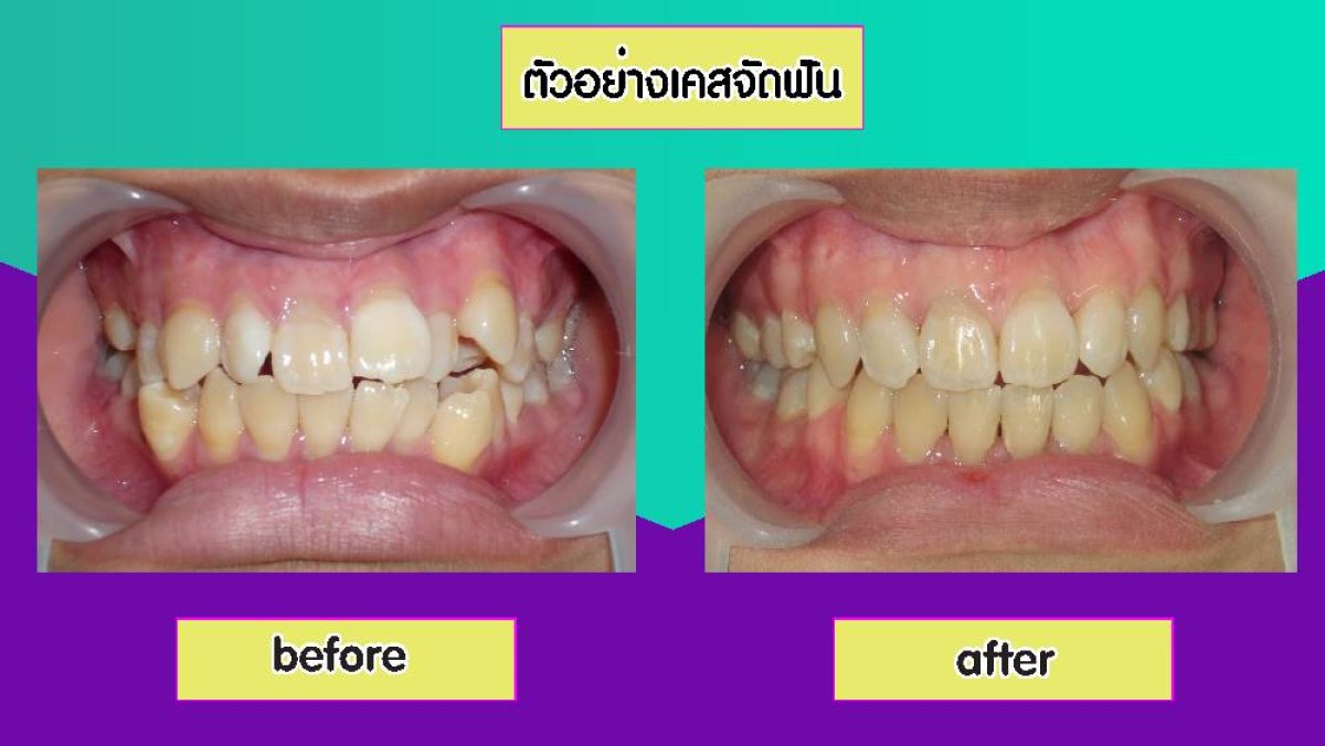 نتائج تقويم الأسنان قبل وبعد في Siam Station Dental Clinic، تحسين انتظام الأسنان
