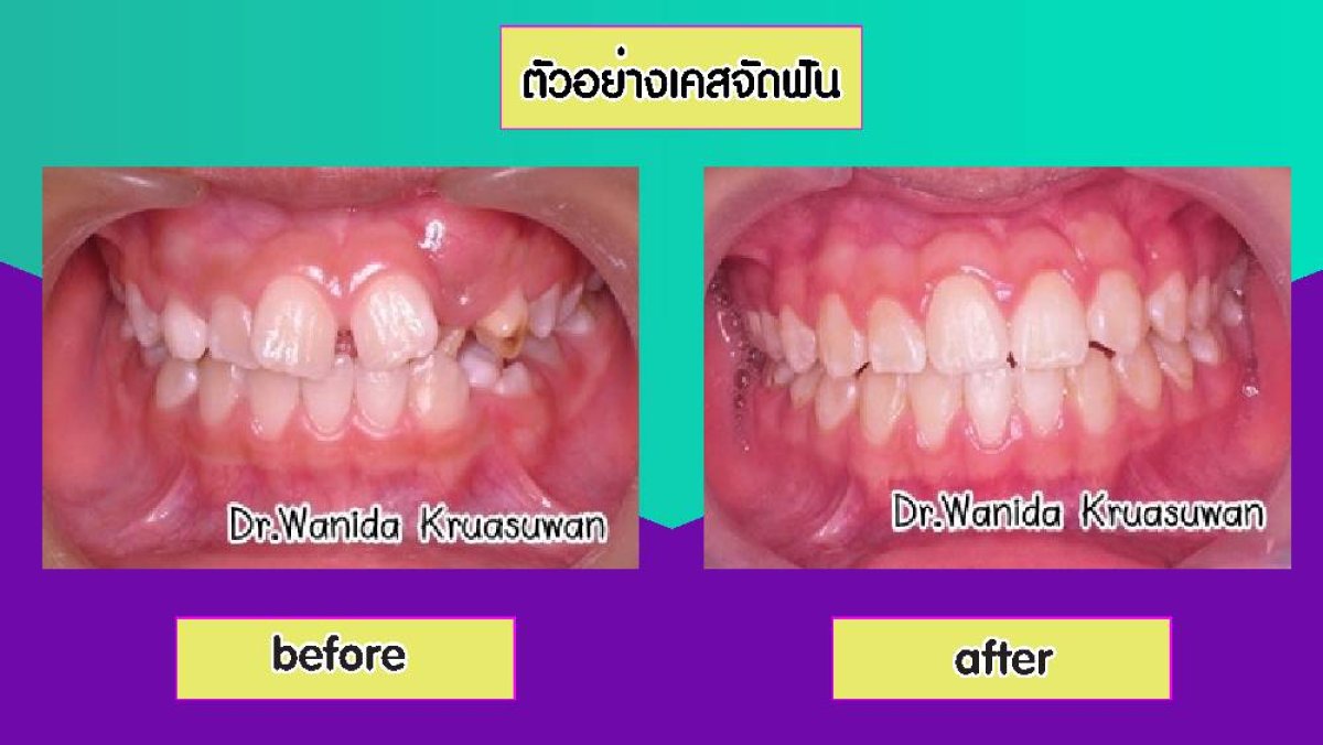 نتائج قبل وبعد تقويم الأسنان في Siam Station Dental Clinic – تحسين انتظام الأسنان