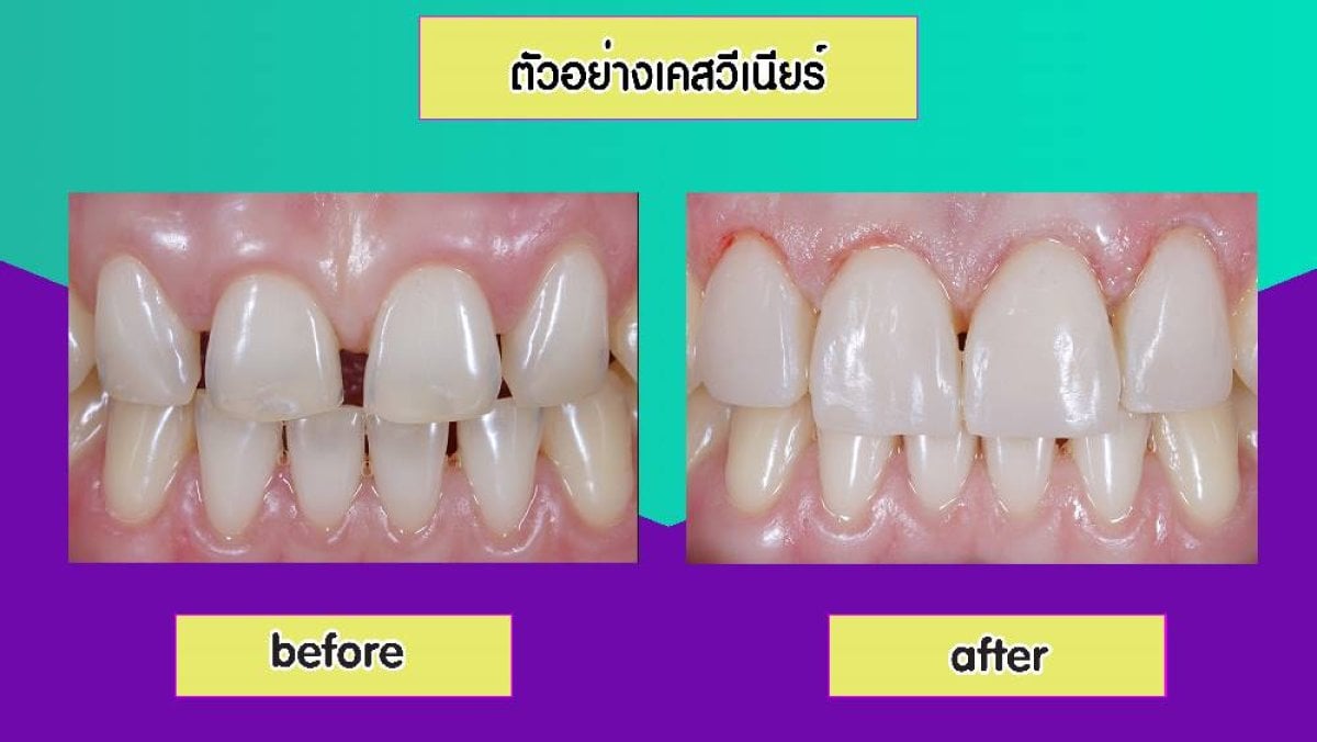 نتائج قبل وبعد عدسات الأسنان الخزفية في Siam Station Dental Clinic، تحسين الابتسامة