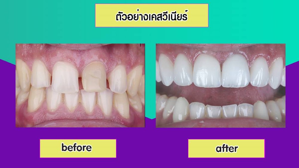 Resultados antes y después de carillas de porcelana en Siam Station Dental Clinic, sonrisa