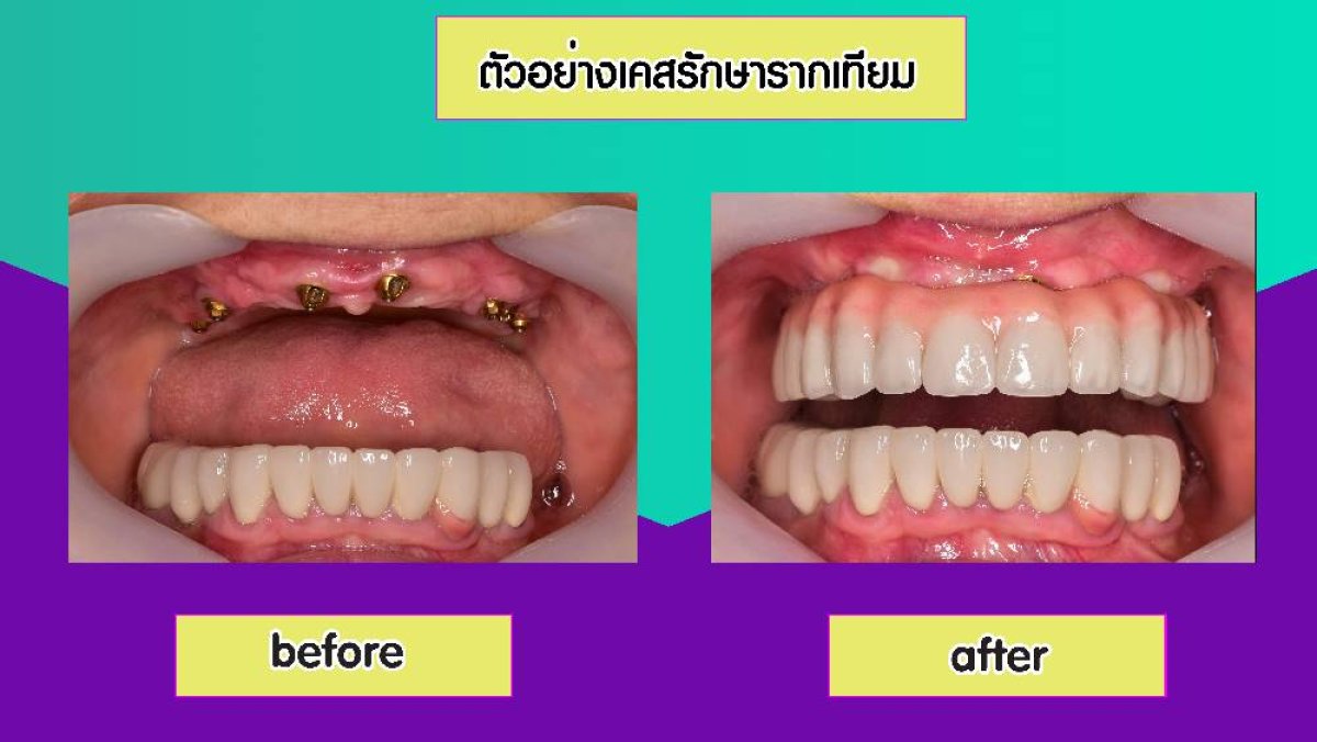 Resultados antes y después de restauración de implantes dentales en Siam Station Dental Clinic