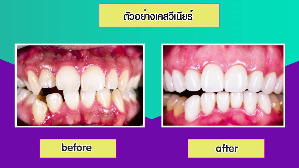 قبل وبعد قشور الأسنان في Siam Station Dental Clinic، نتيجة تحول الابتسامة