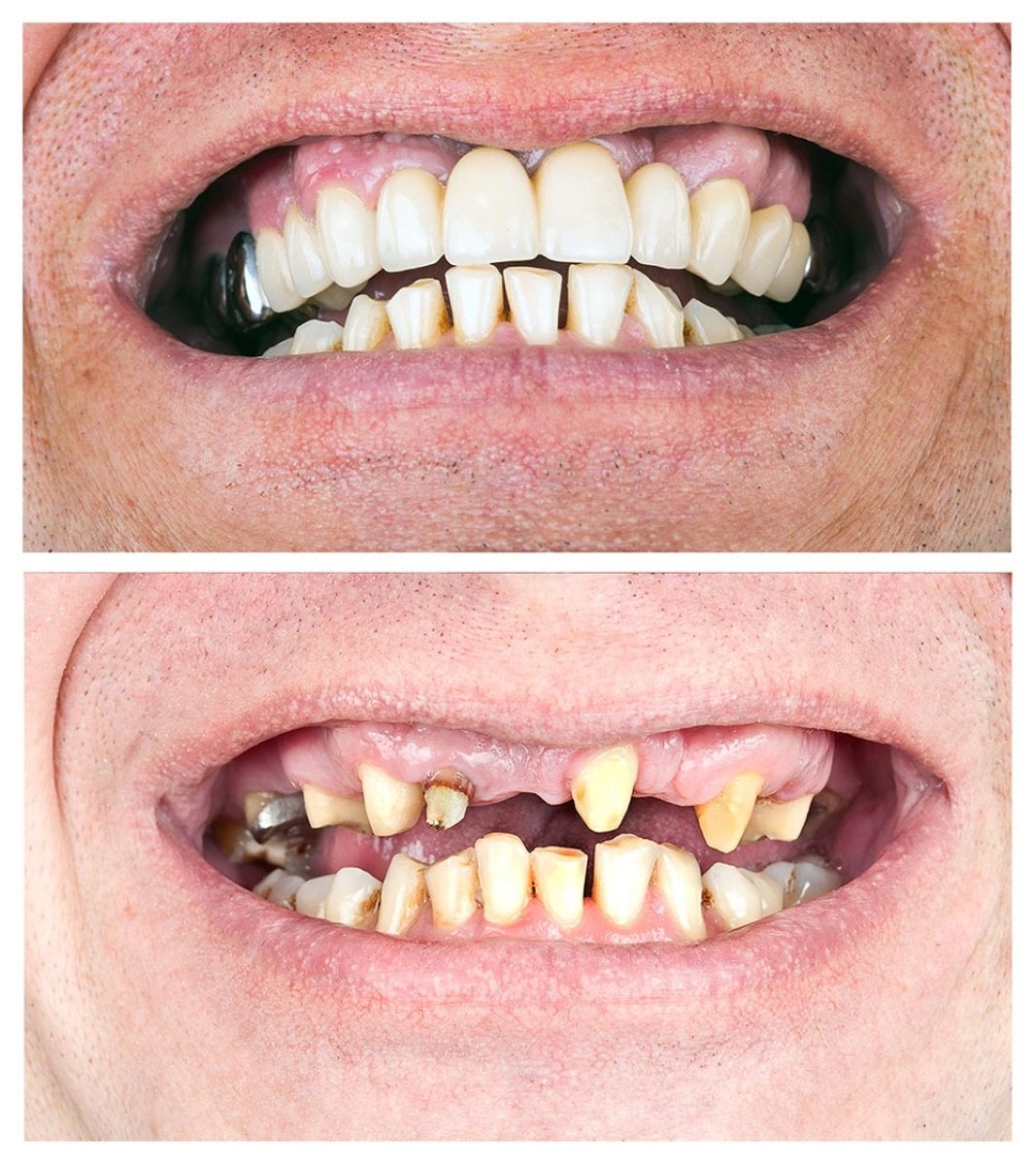قبل وبعد الفينير في Siam Station Dental Clinic – نتائج استعادة الابتسامة