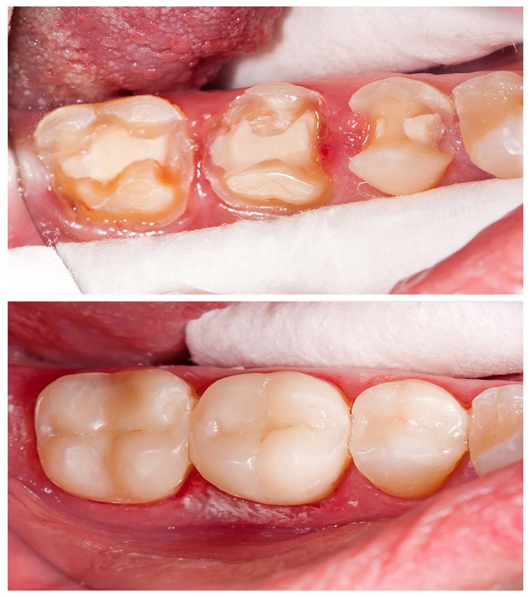 نتائج قبل وبعد حشو الكمبوزيت في عيادة Siam Station Dental Clinic، ترميم الأضراس