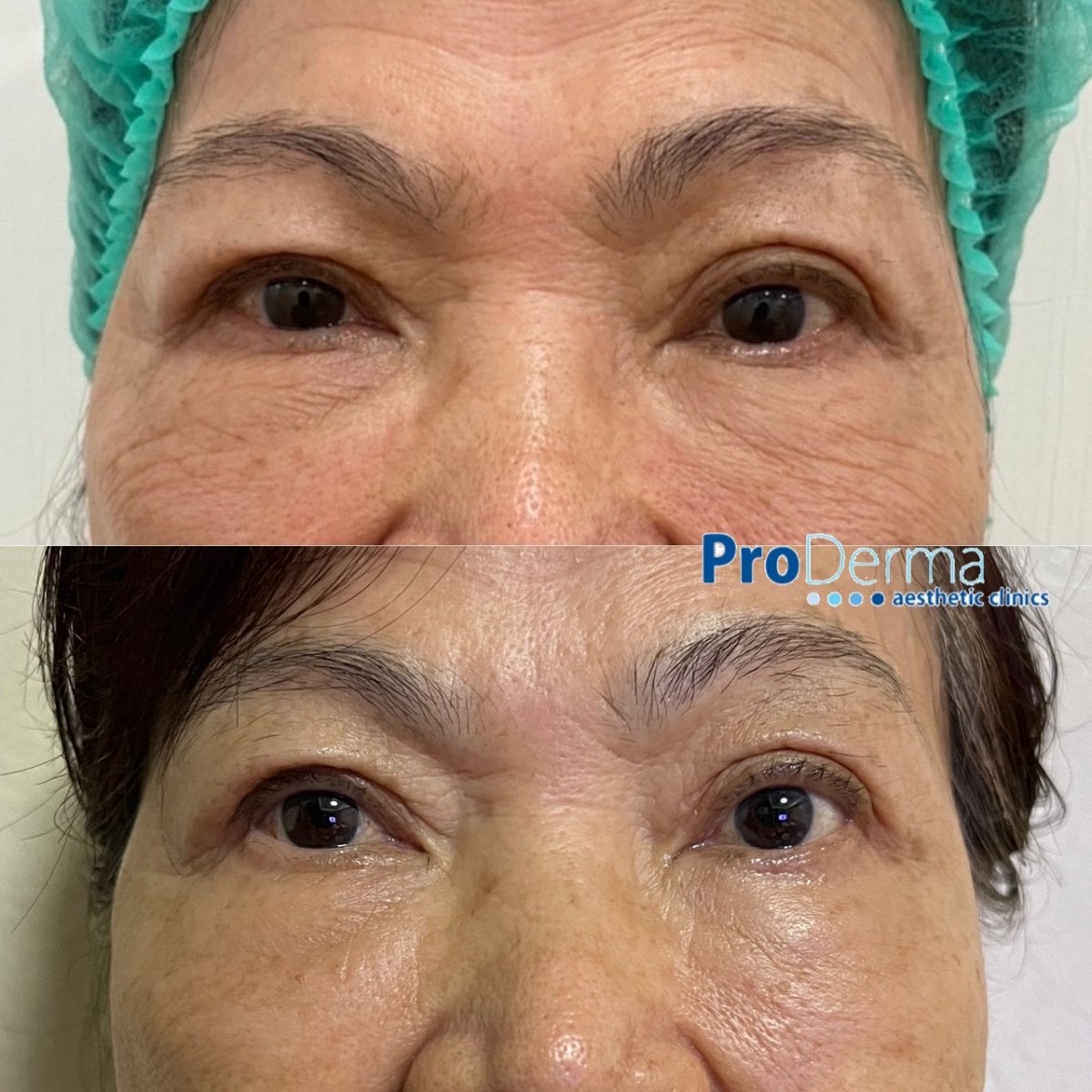 قبل وبعد بوتوكس التجاعيد في ProDerma، تقليل واضح لخطوط منطقة العين