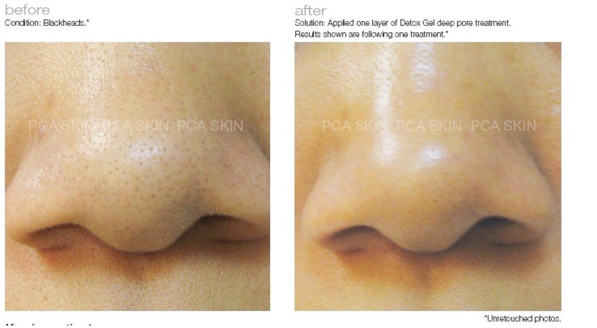 نتائج التقشير الكيميائي في ProDerma – تقليل الرؤوس السوداء على الأنف