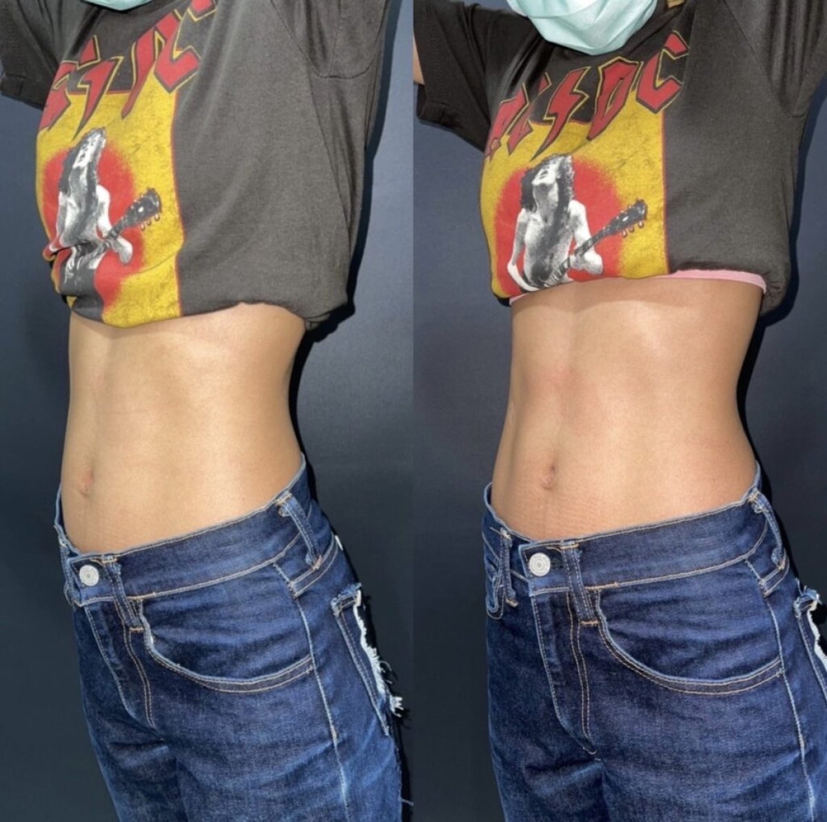 Antes y después de criolipólisis en ProDerma: reducción visible de grasa abdominal