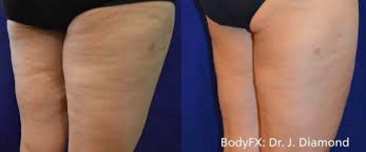 Resultados antes y después de reducción de celulitis en ProDerma, muslos más lisos