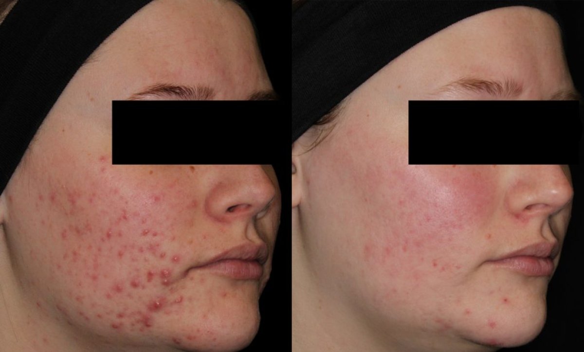 Resultados antes y después del tratamiento de cicatrices de acné en ProDerma: piel más clara