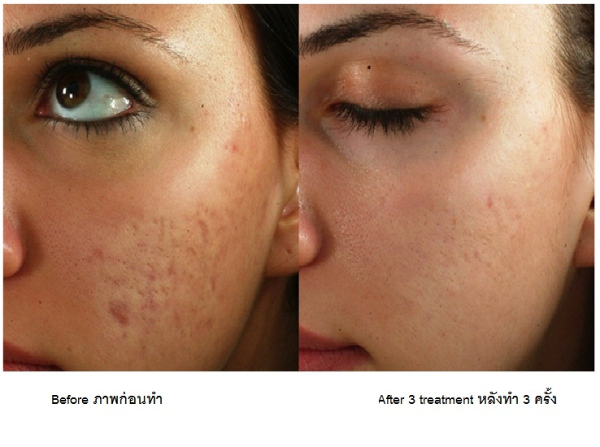 نتائج علاج ندبات حب الشباب في ProDerma – تحسن ملموس في ملمس البشرة