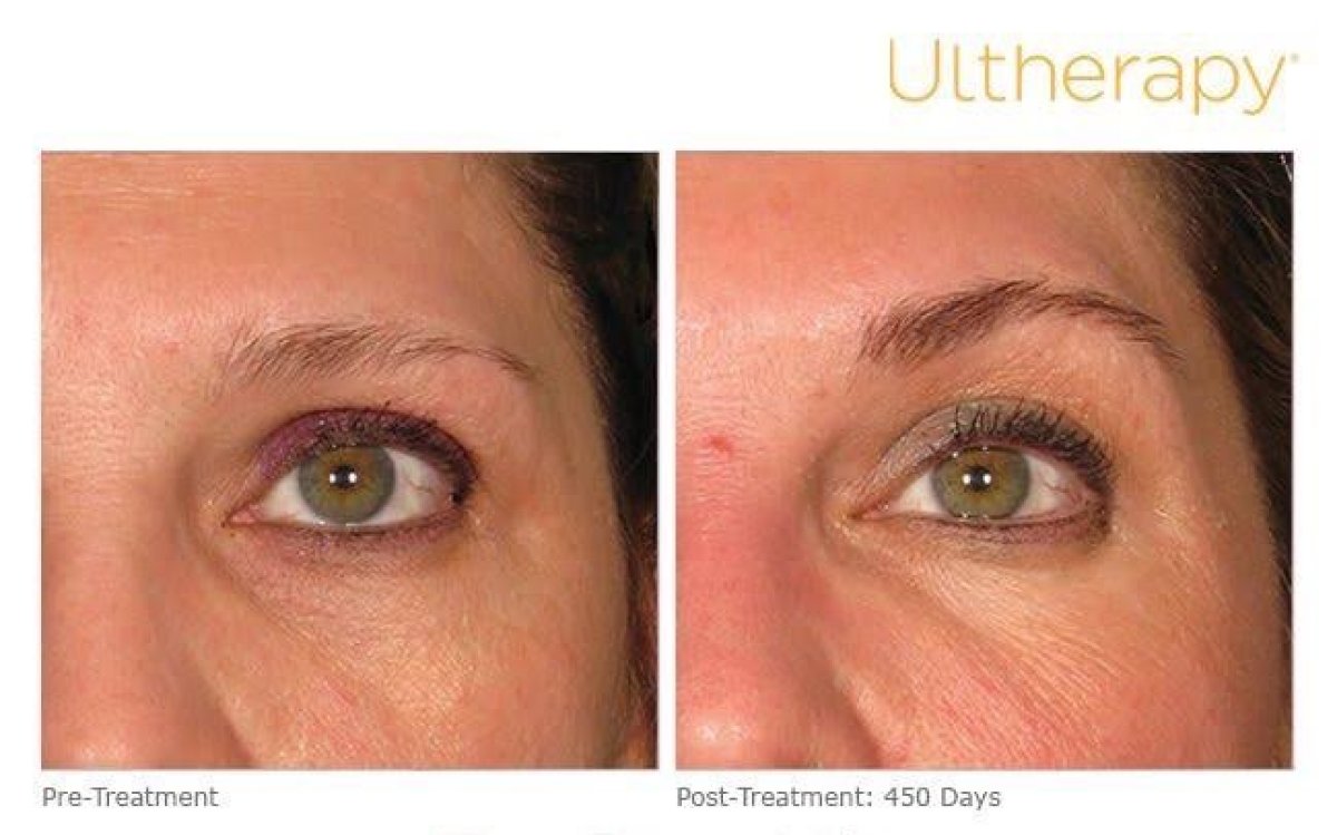 Resultados de rejuvenecimiento ocular con Ultherapy en ProDerma – menos arrugas