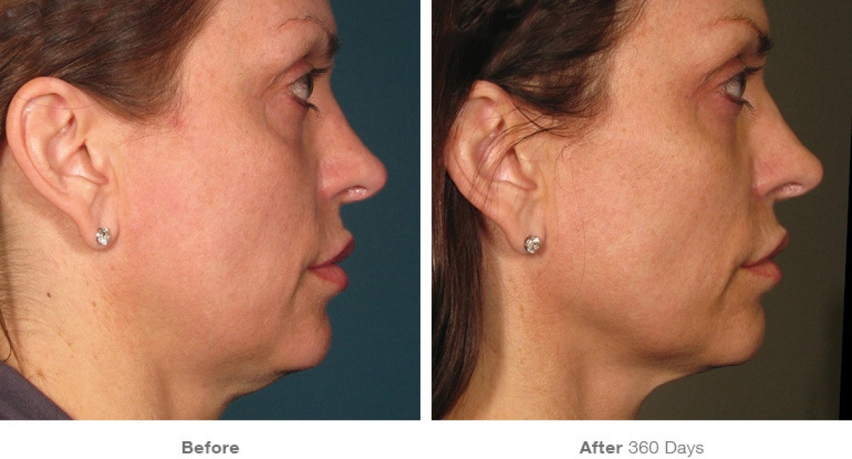 Antes y después de lifting facial sin cirugía en ProDerma – mejora visible del contorno facial
