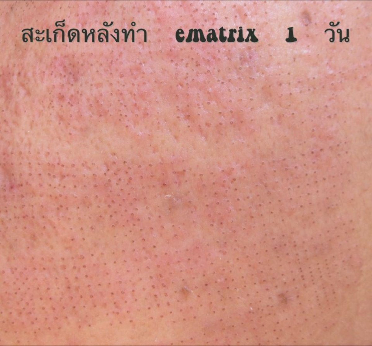 نتيجة علاج ليزر CO2 في ProDerma، تحسن ملمس البشرة بعد الإجراء