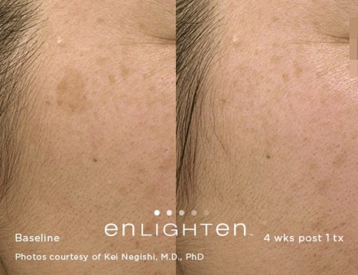 نتائج علاج ليزر VBeam في ProDerma – تقليل تصبغات الوجه بعد 4 أسابيع