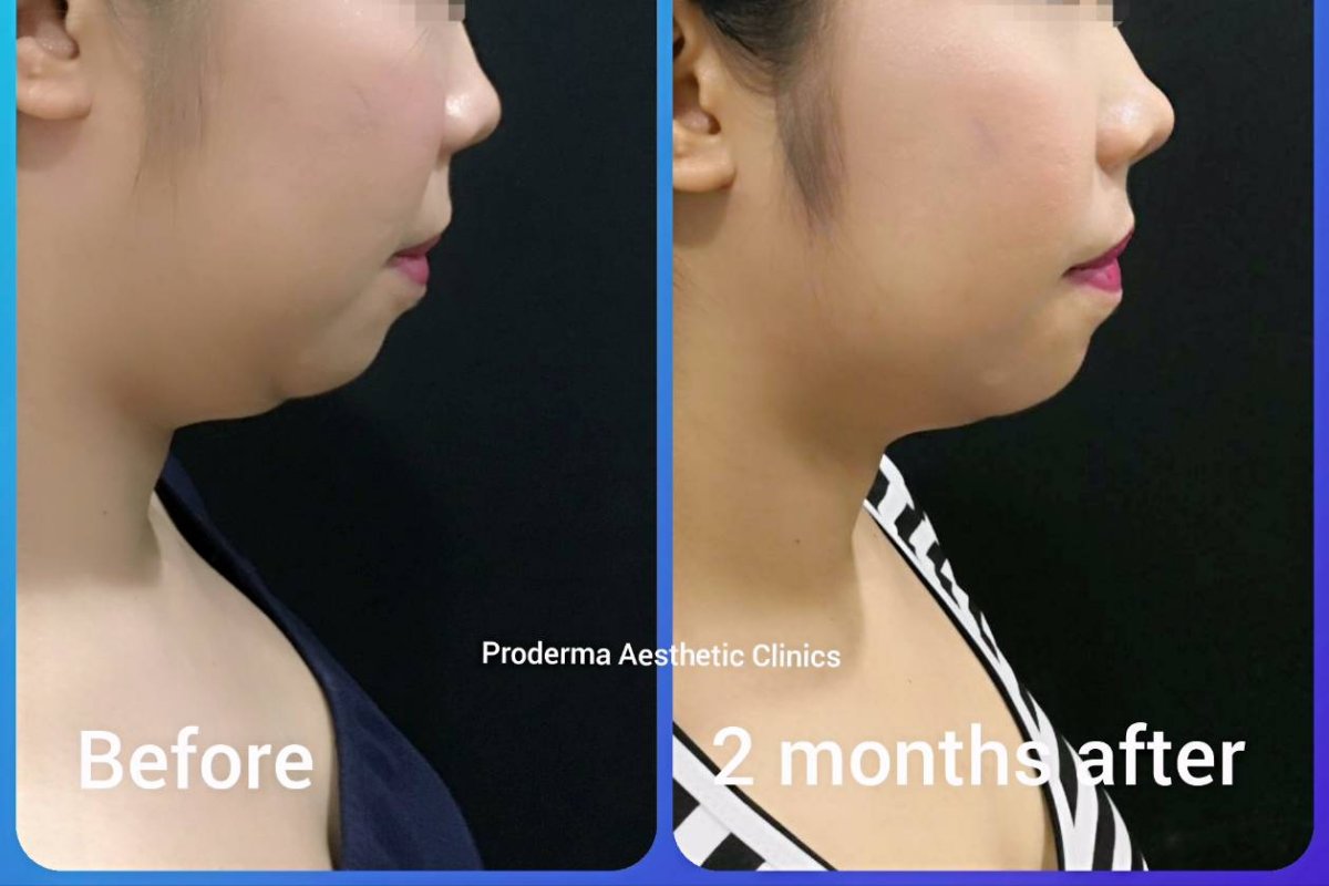 Antes y después de contorno de mandíbula en ProDerma: mejor definición de mentón y mandíbula