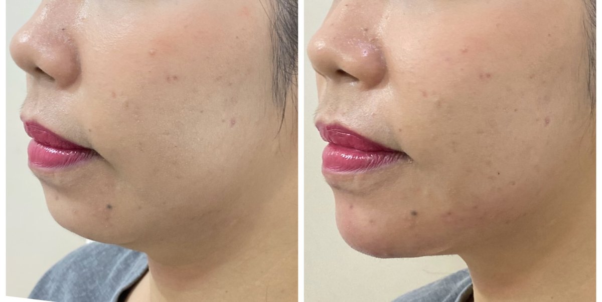 نتائج تحديد خط الفك قبل وبعد في ProDerma، إبراز الذقن والفك