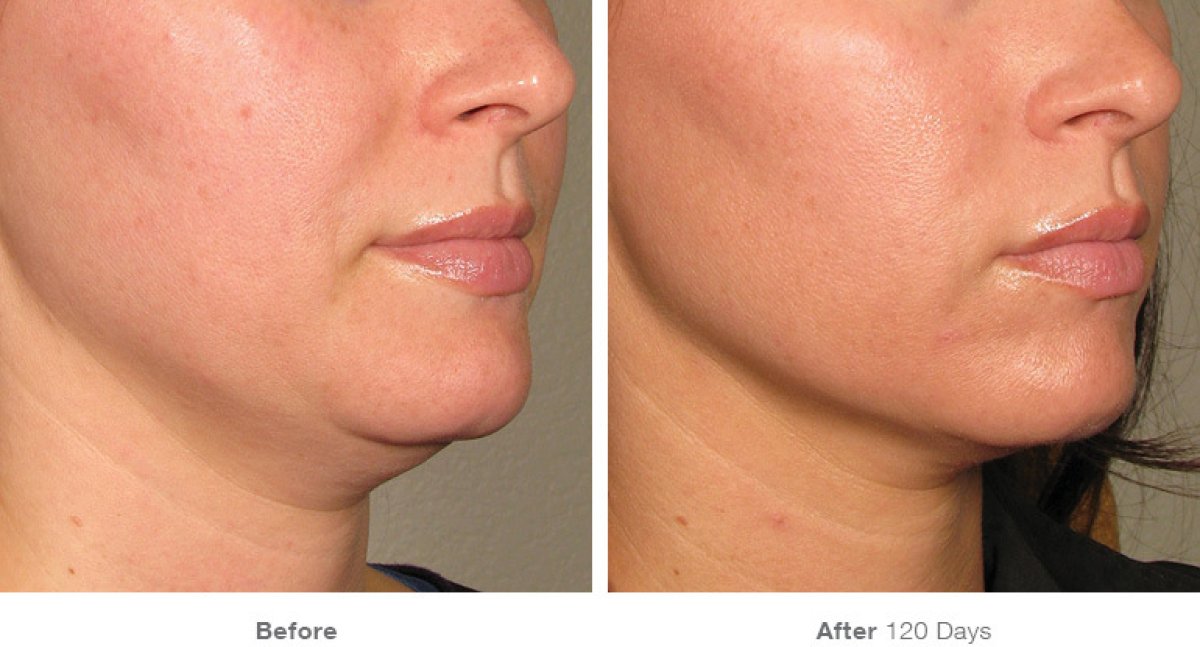 Antes y después de contorno de mandíbula en ProDerma, mejora en la definición del mentón