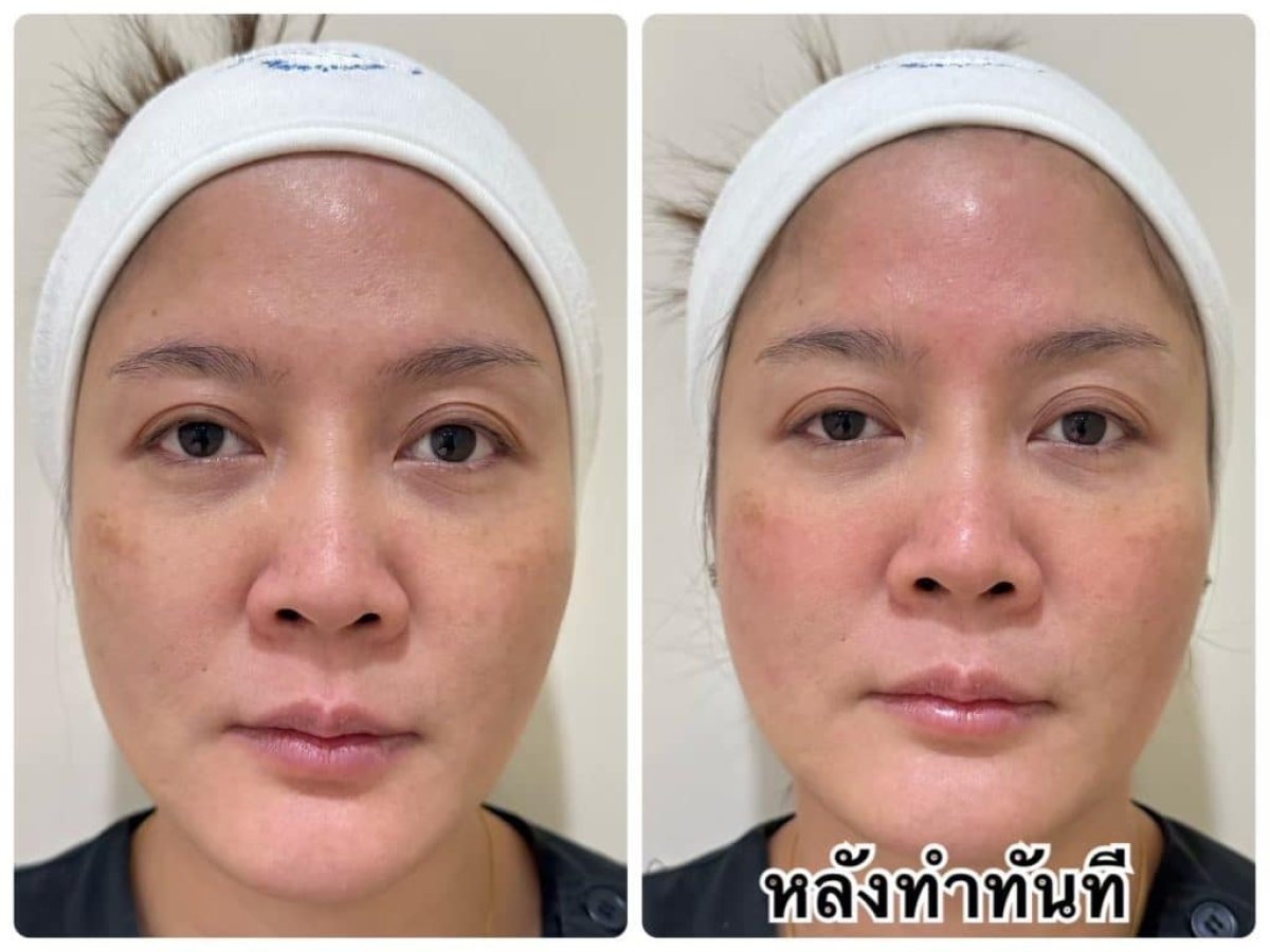 Antes y después de inyectables antiarrugas en ProDerma, resultado de rejuvenecimiento facial
