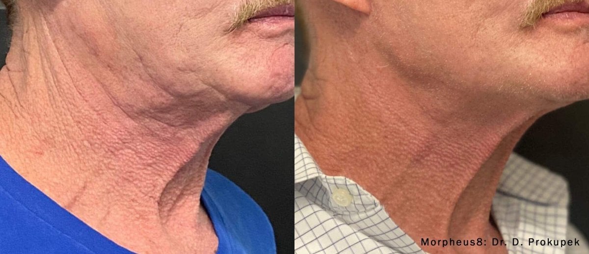 Resultados antes y después de tensado facial y cuello Morpheus8 en ProDerma