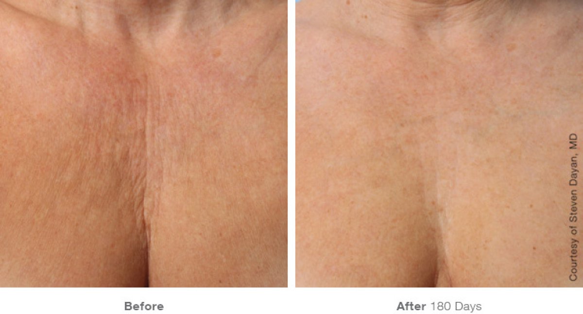 نتائج Morpheus 8 Body في ProDerma – تحسين ملمس جلد الصدر قبل وبعد