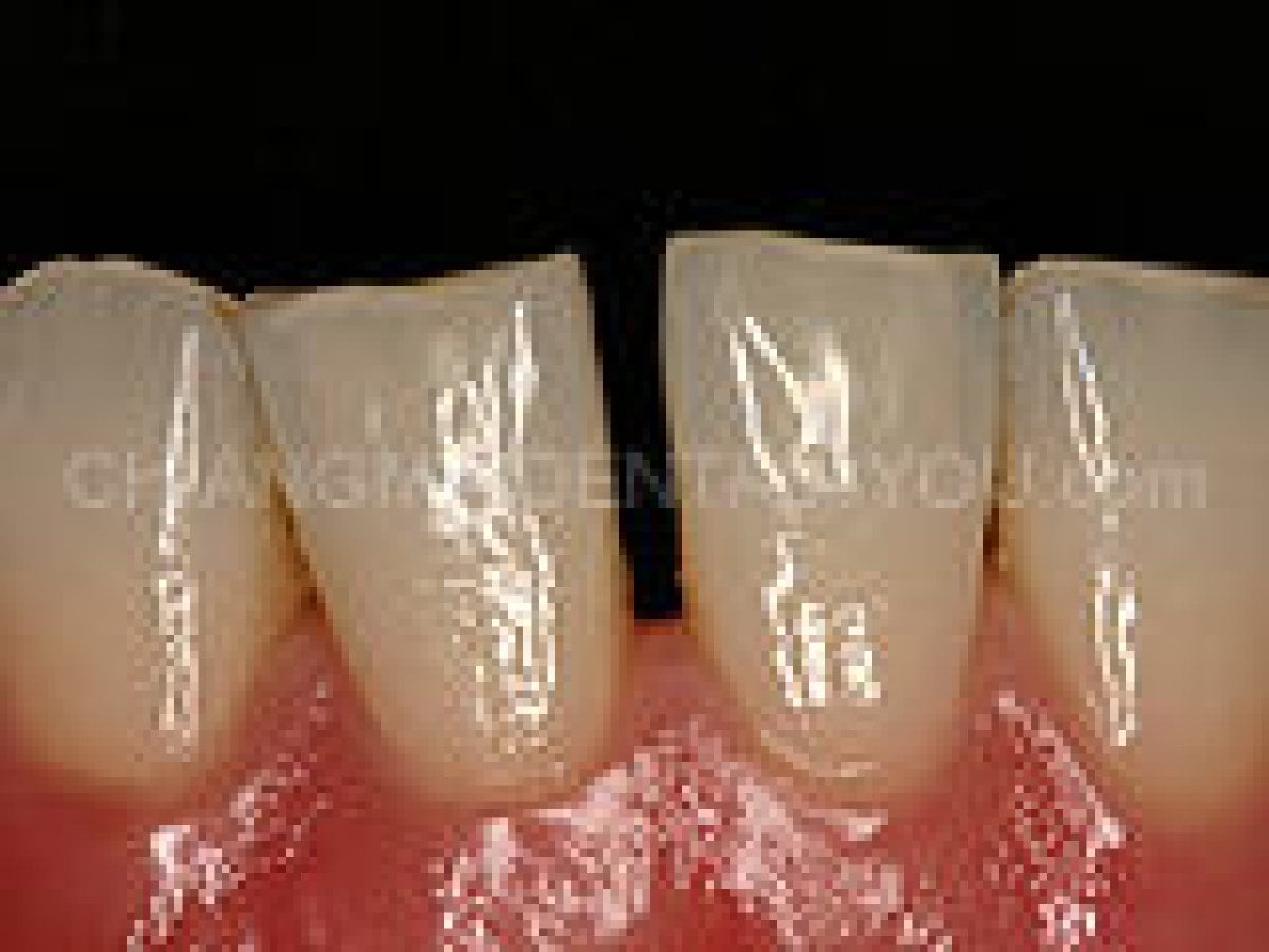 نتيجة تنظيف الأسنان (إزالة الجير) في Dental 4 You Clinic – أسنان أنظف وأكثر صحة