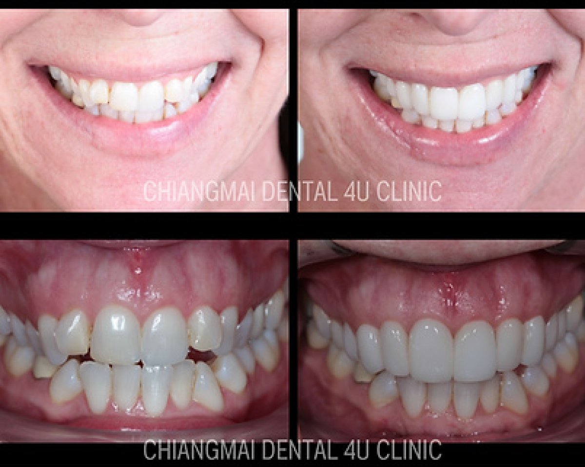 Resultados de blanqueamiento dental antes y después en Dental 4 You Clinic, sonrisa brillante
