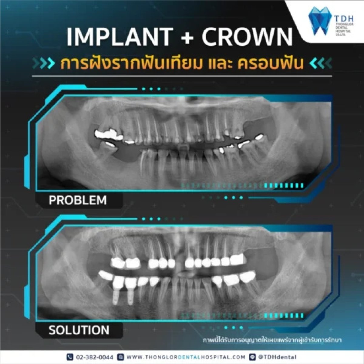 نتائج قبل وبعد زراعة الأسنان مع التاج في Thonglor Dental Hospital، ابتسامة محسنة