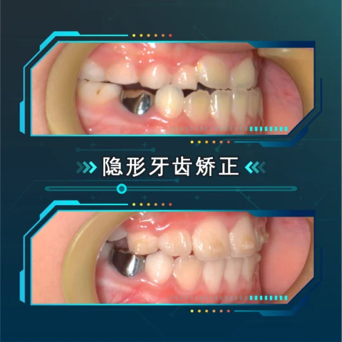 نتائج تقويم الأسنان الشفاف قبل وبعد في Thonglor Dental Hospital، تحسين اصطفاف الأسنان