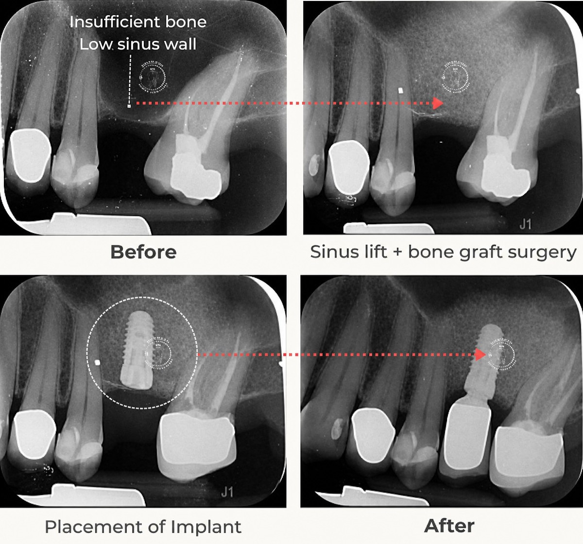 Antes y después de implante dental con elevación sinusal e injerto óseo en Empress Dental, resultado