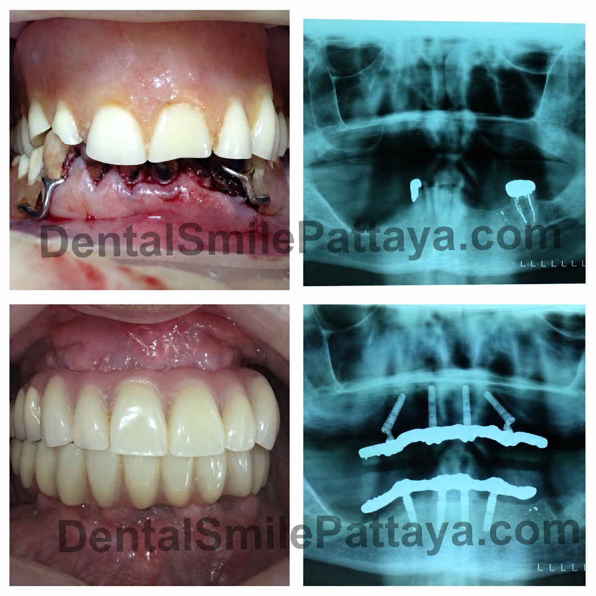 Resultado antes y después de implantes All-on-4 en Dental Smile Clinic - Pattaya Dentist
