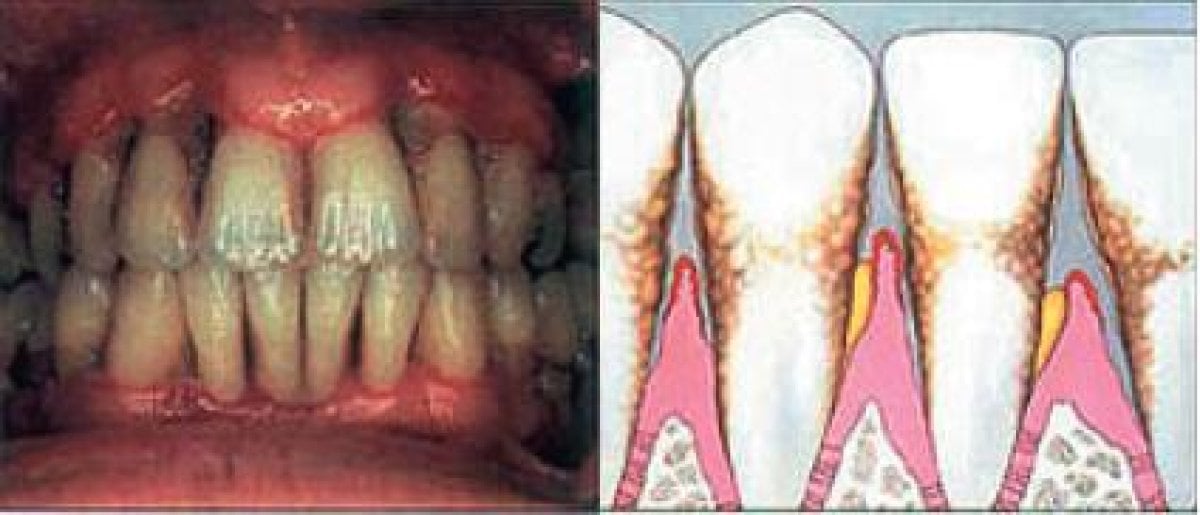 نتائج تنظيف الأسنان العميق في Dental Smile Clinic - Pattaya Dentist، إزالة الجير