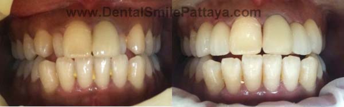 نتائج تبييض الأسنان قبل وبعد في Dental Smile Clinic - Pattaya Dentist، ابتسامة أكثر إشراقًا
