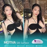 До и после увеличения груди имплантами Motiva в Wansiri Hospital, видимый результат
