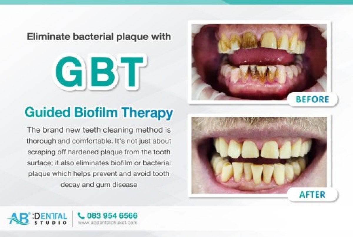 نتائج قبل وبعد تنظيف الأسنان العميق (GBT) في A.B. Dental Studio، إزالة البلاك