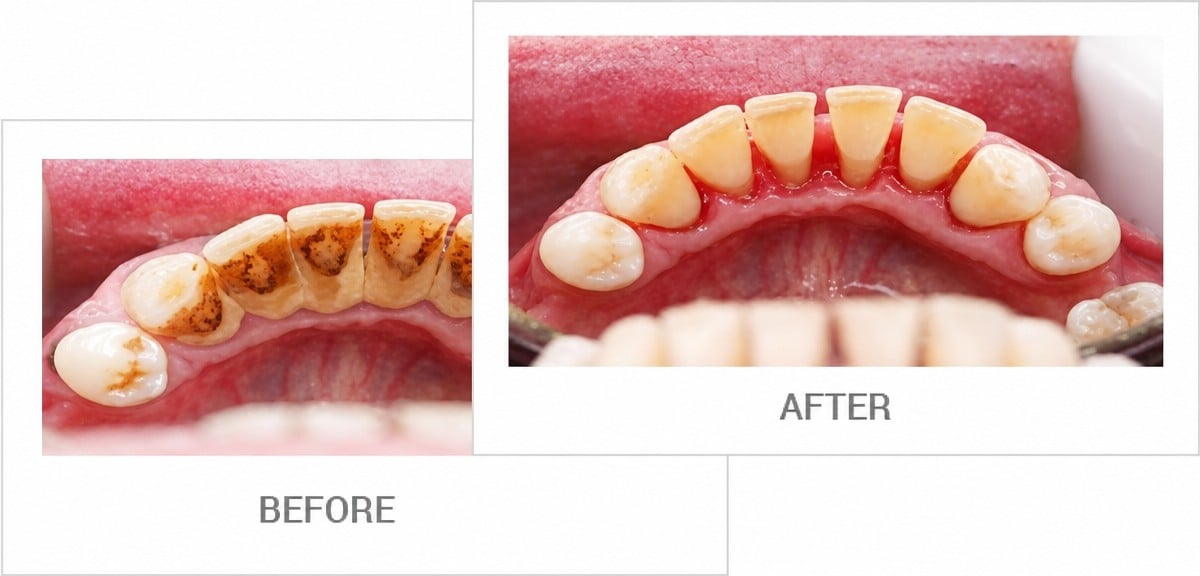 نتائج قبل وبعد تنظيف عميق للأسنان (تقشير الجذور) في A.B. Dental Studio
