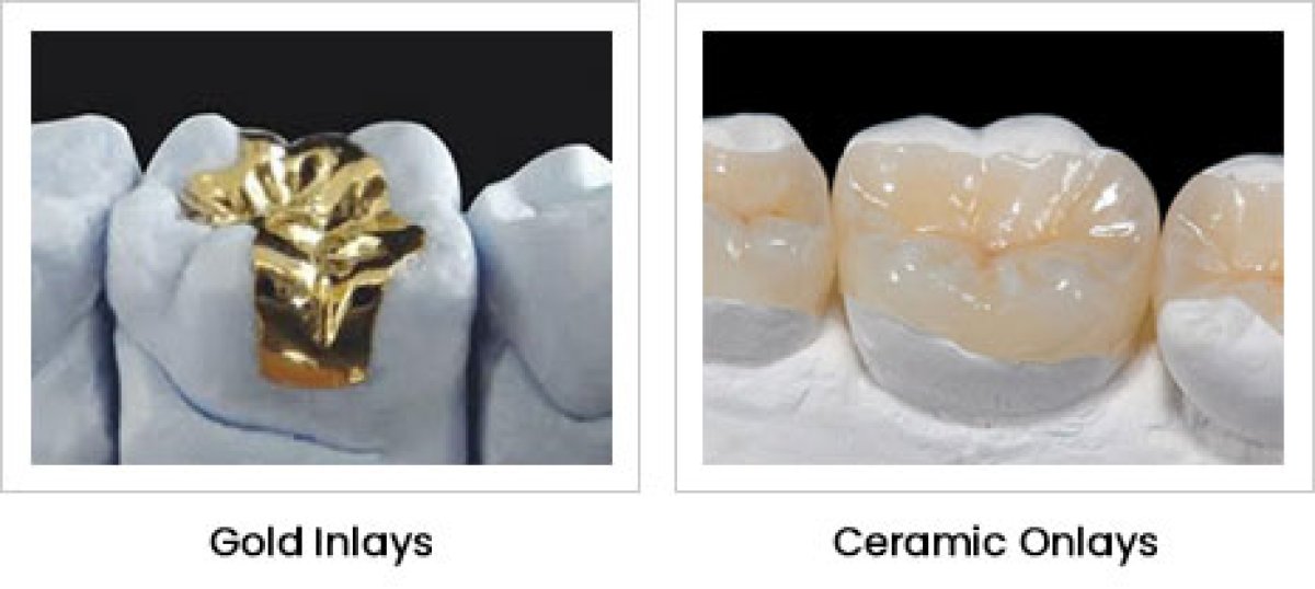 Comparación de restauraciones dentales con incrustación de oro y onlay cerámico en A.B. Dental Studio
