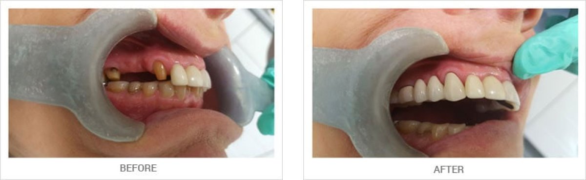 Antes y después de carillas dentales en A.B. Dental Studio: resultados de restauración de sonrisa