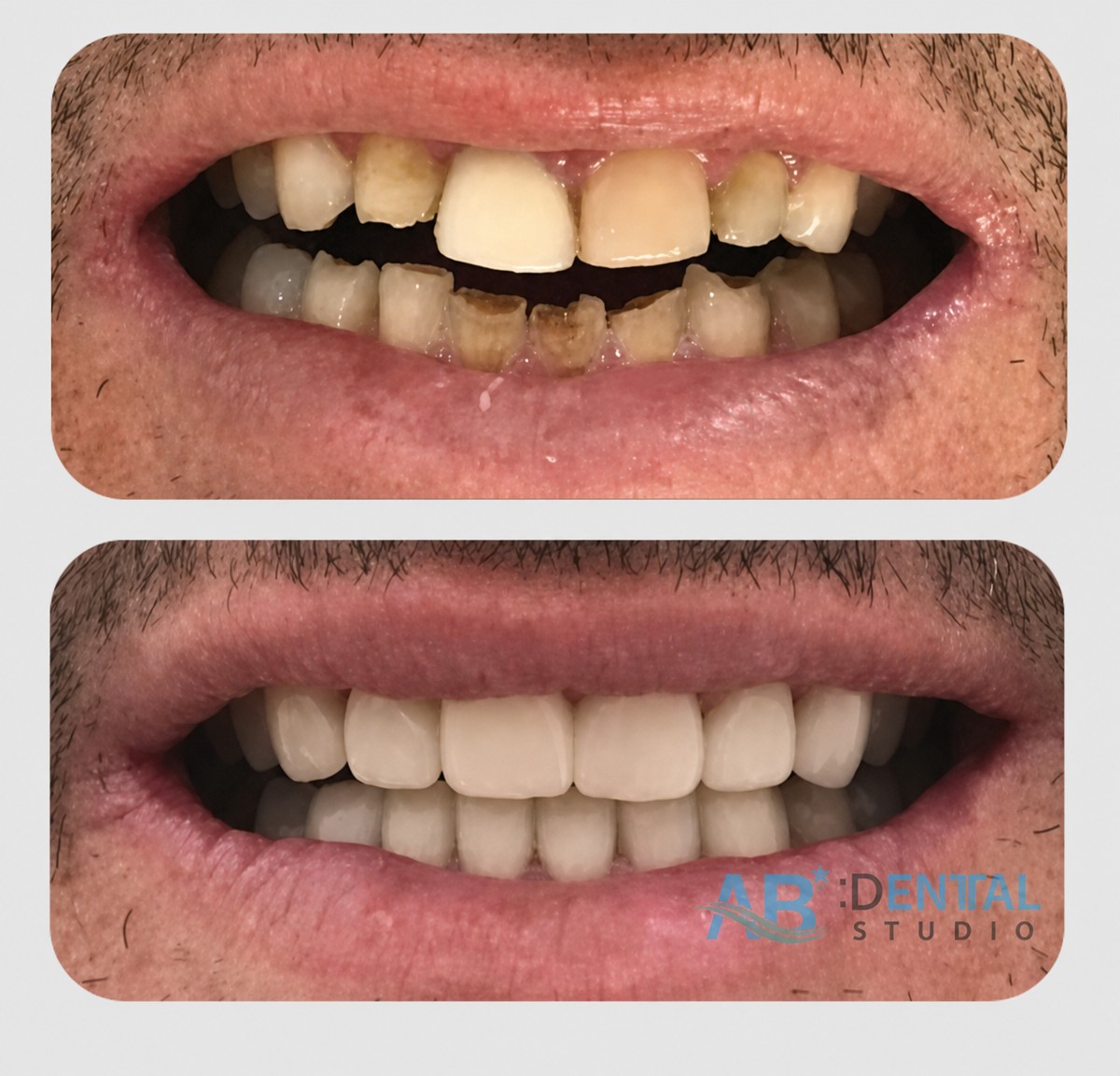 نتائج قبل وبعد الفينير في A.B. Dental Studio – ابتسامة طبيعية المظهر