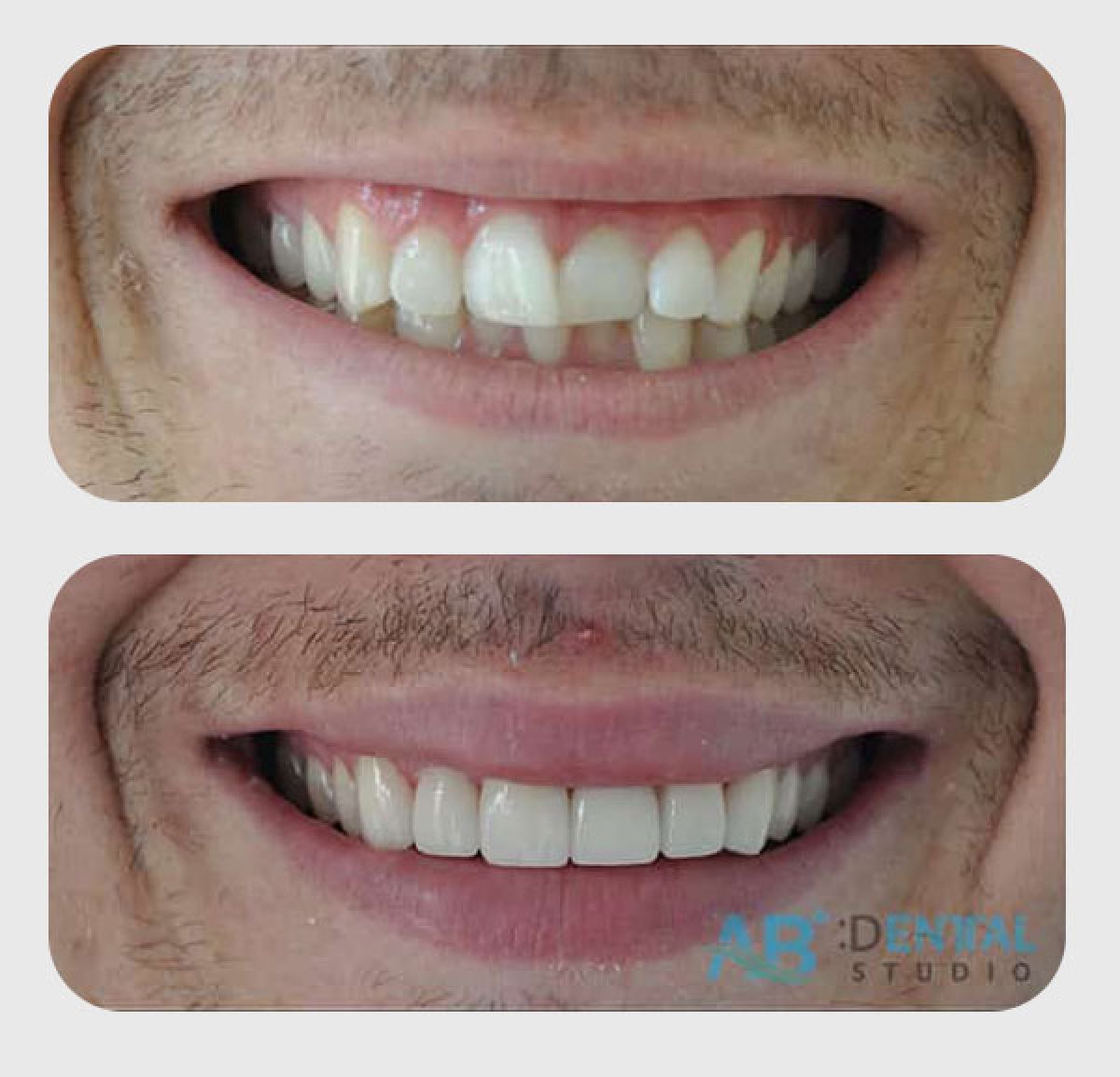 Antes y después de carillas dentales en A.B. Dental Studio – sonrisa natural y renovada