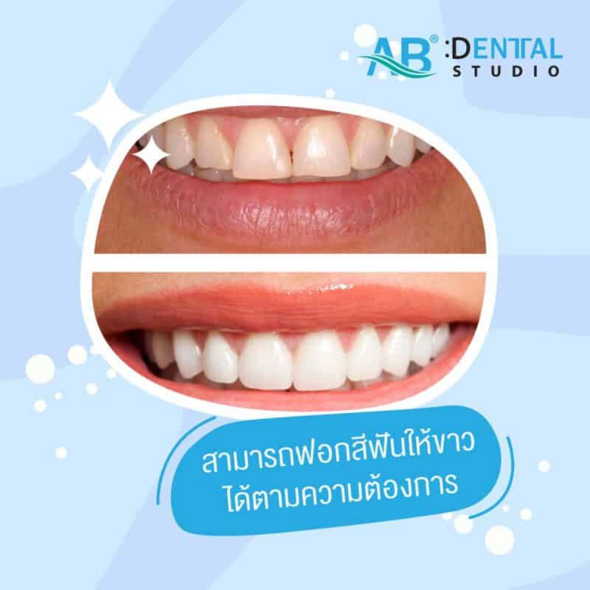 Resultados de blanqueamiento dental antes y después en A.B. Dental Studio – sonrisa más blanca