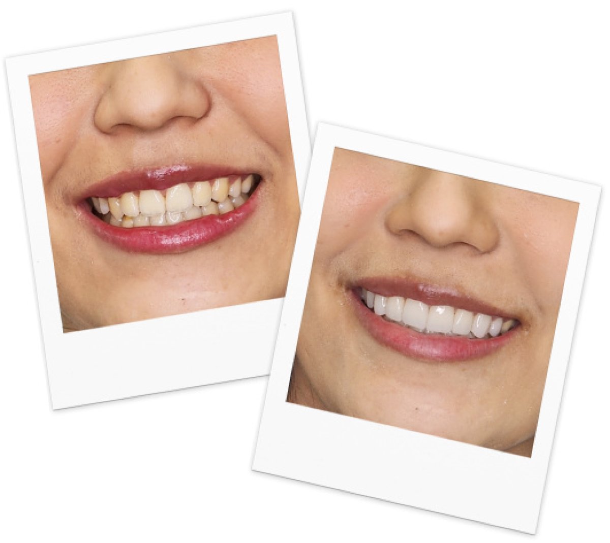نتائج تبييض الأسنان قبل وبعد في A.B. Dental Studio – ابتسامة أكثر إشراقًا